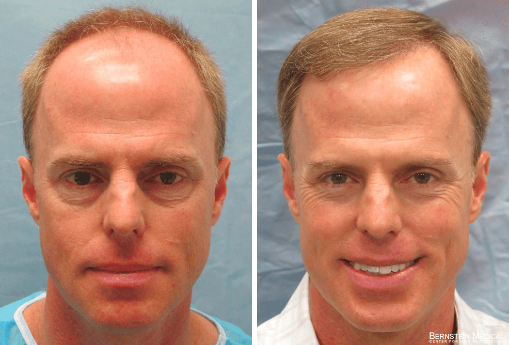 Bernstein Medical - Patient RFR Before and After Hair Transplant Photo 