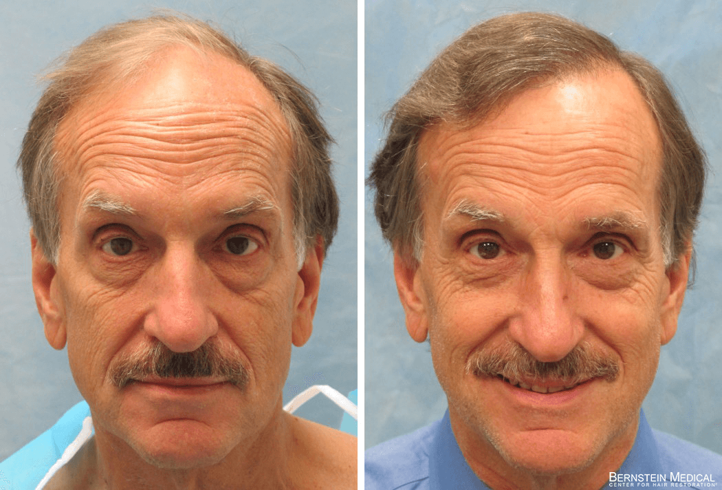 Bernstein Medical - Patient RIR Before and After Hair Transplant Photo 