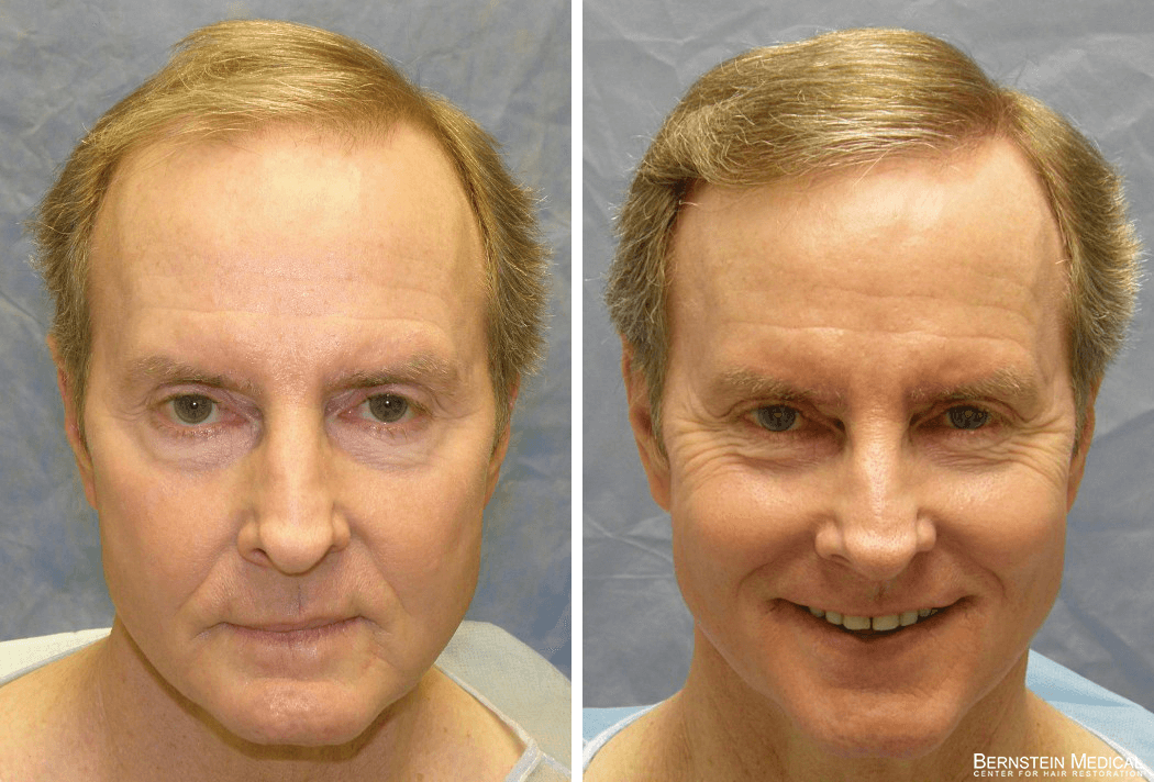 Bernstein Medical - Patient RKS Before and After Hair Transplant Photo 