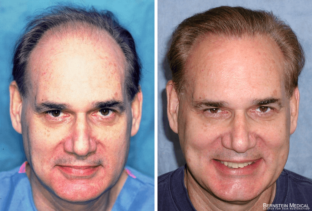 Bernstein Medical - Patient RND Before and After Hair Transplant Photo 