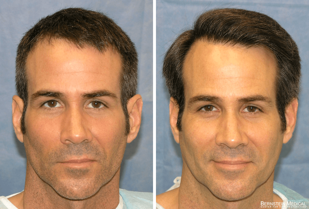 Bernstein Medical - Patient RPC Before and After Hair Transplant Photo 