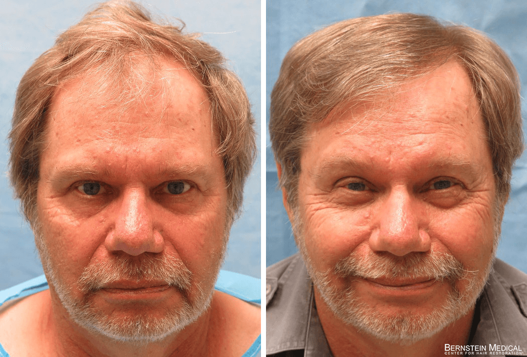 Bernstein Medical - Patient RPE Before and After Hair Transplant Photo 