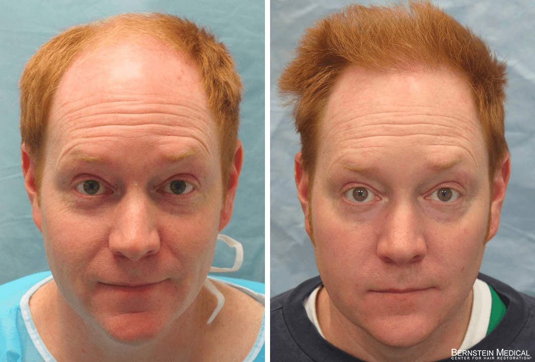 Bernstein Medical - Patient RYL Before and After Hair Transplant Photo 