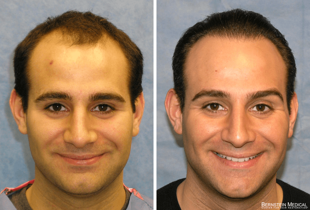 Bernstein Medical - Patient SAE Before and After Hair Transplant Photo 
