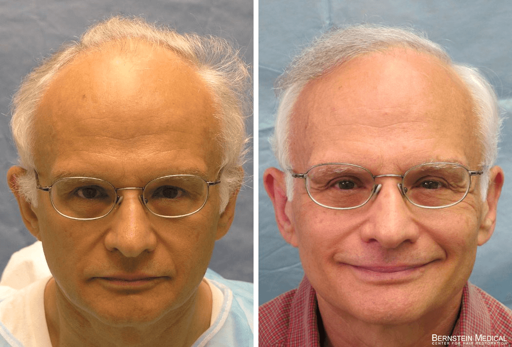 Bernstein Medical - Patient SFI Before and After Hair Transplant Photo 