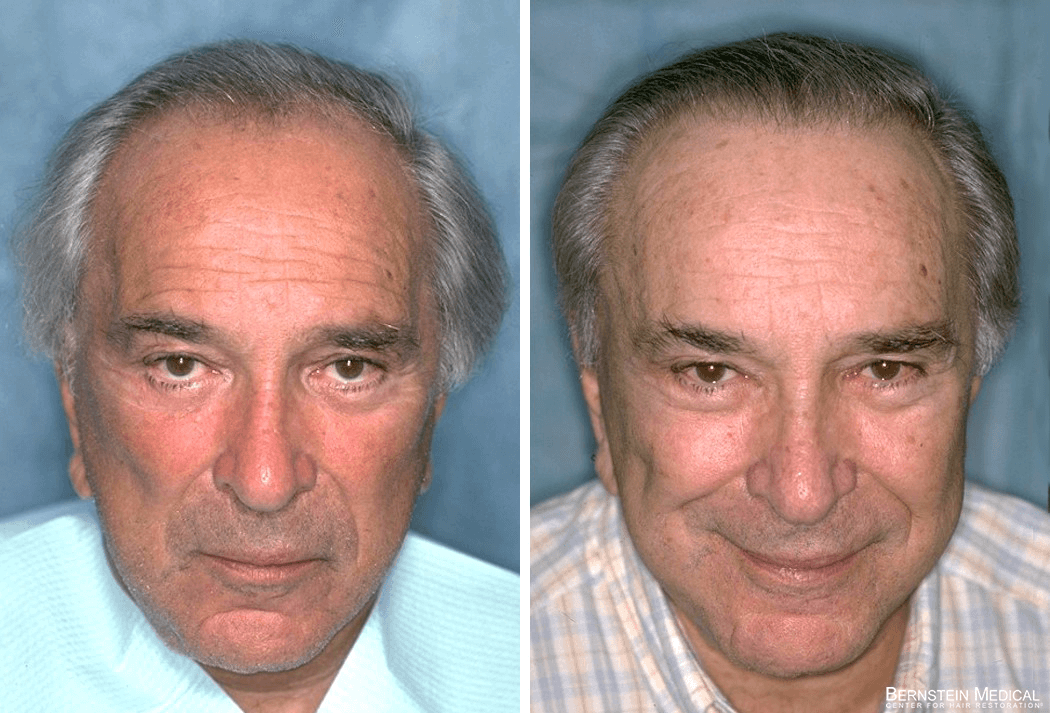 Bernstein Medical - Patient SOI – Portrait Before and After Hair Transplant Photo 