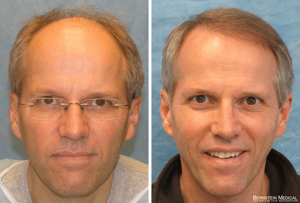 Bernstein Medical - Patient STQ Before and After Hair Transplant Photo 