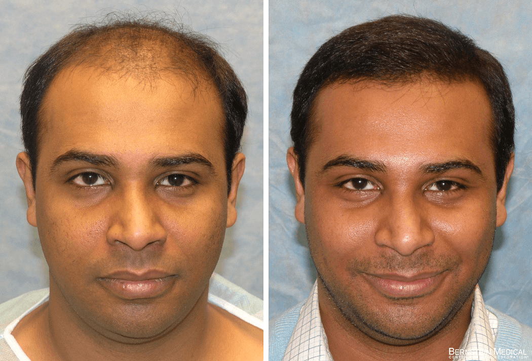 Patient UAR | Bernstein Medical - Center for Hair Restoration