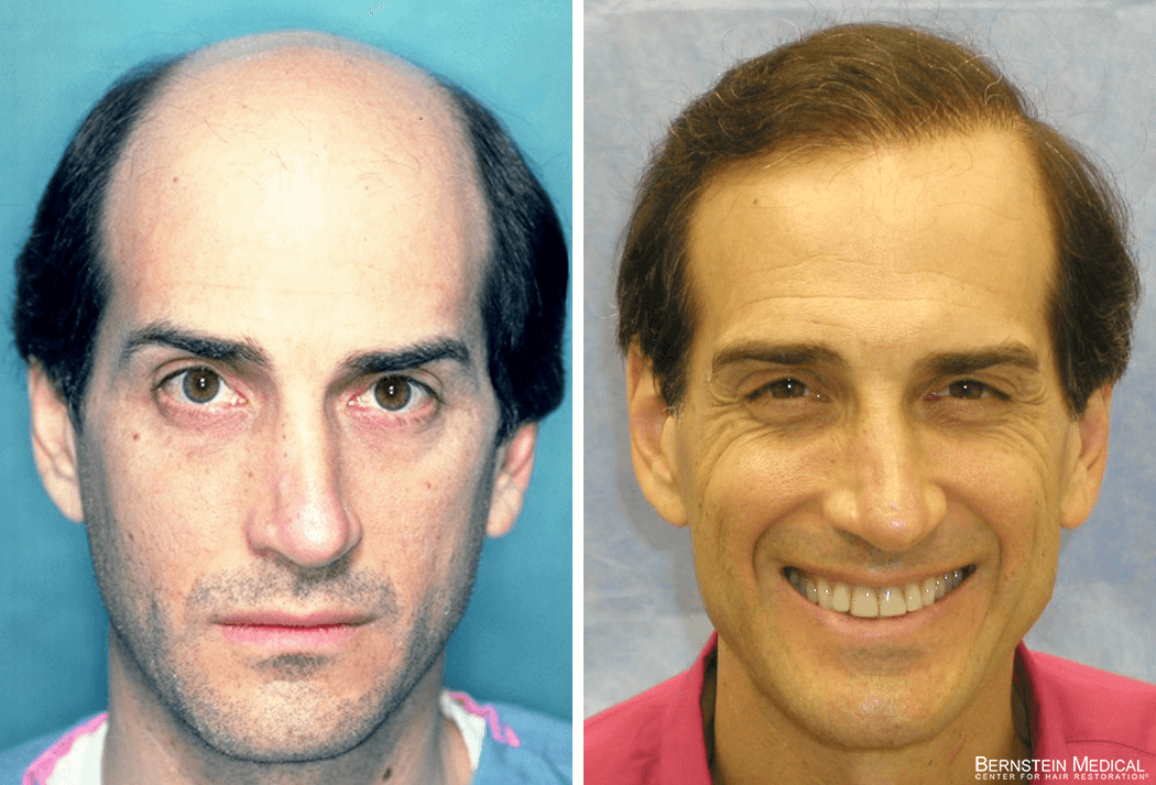 Bernstein Medical - Patient URQ Before and After Hair Transplant Photo 