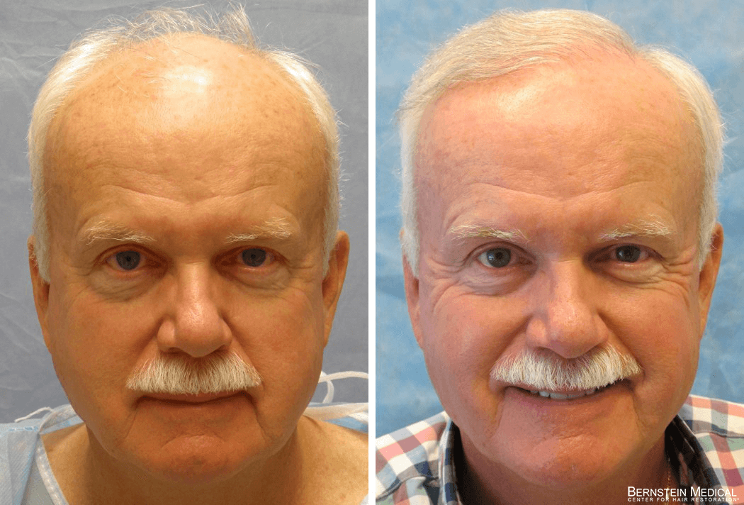 Bernstein Medical - Patient UTQ Before and After Hair Transplant Photo 