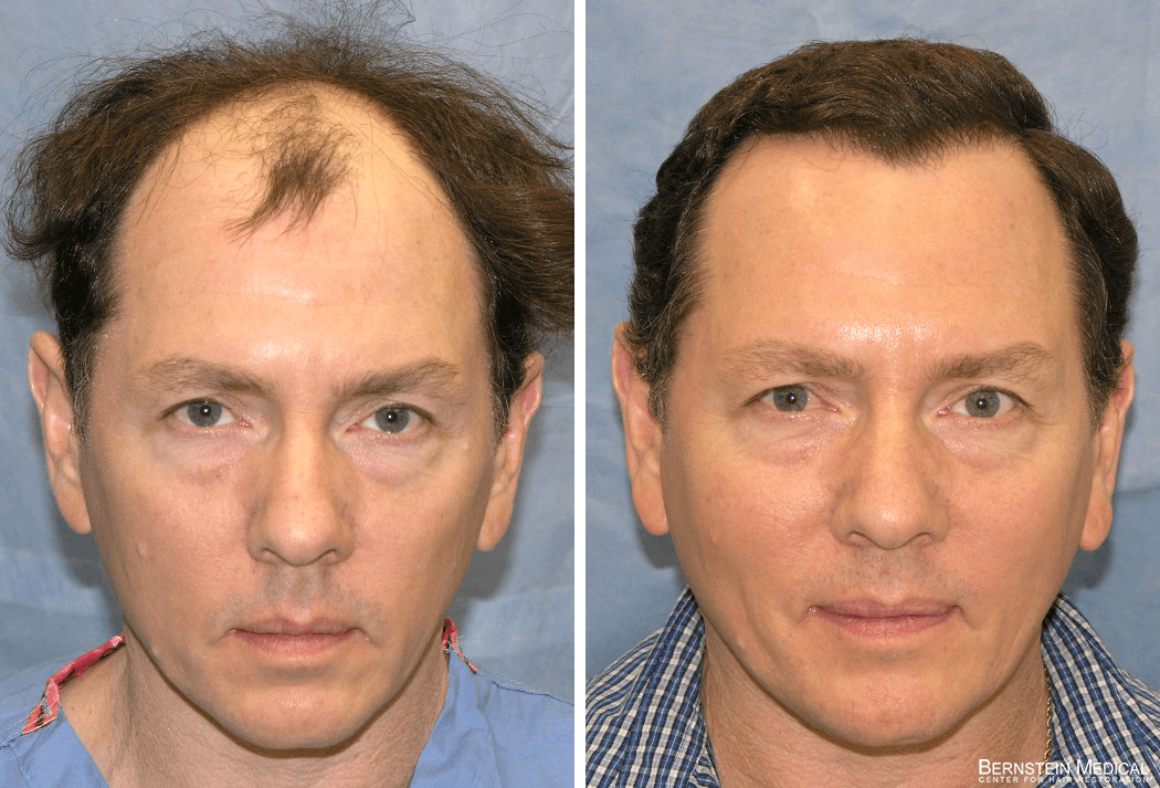 Bernstein Medical - Patient VKI Before and After Hair Transplant Photo 