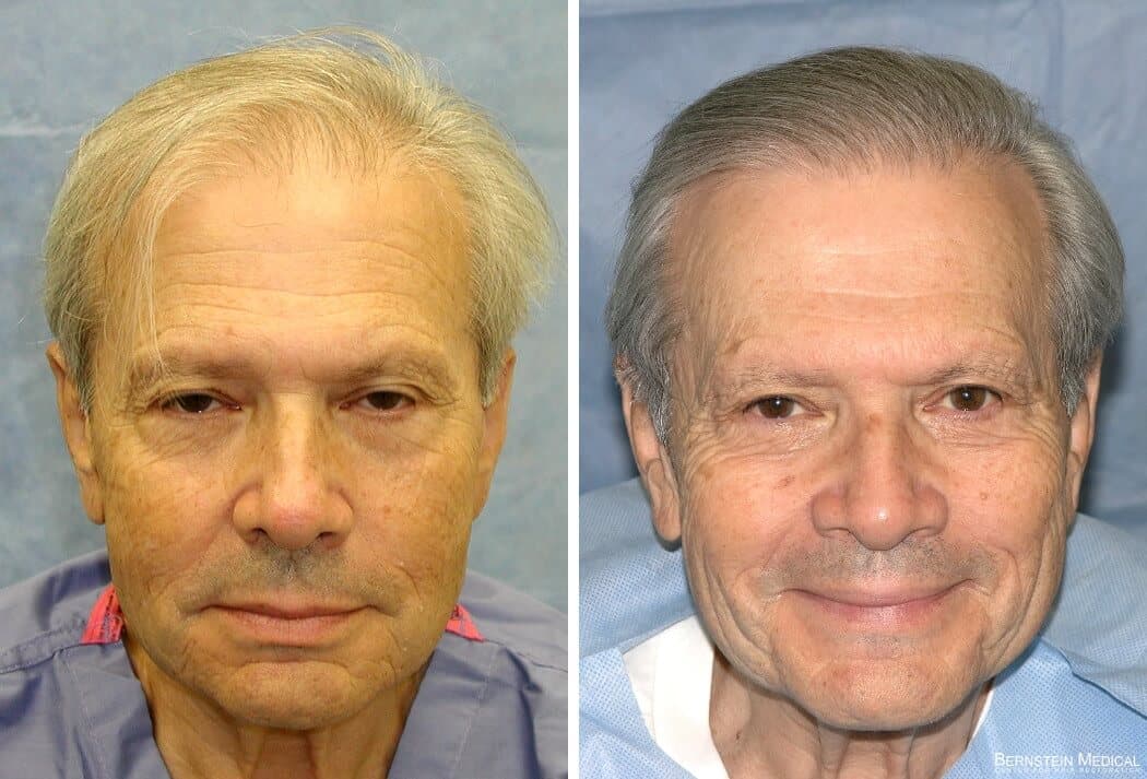 Bernstein Medical - Patient VSI Before and After Hair Transplant Photo 