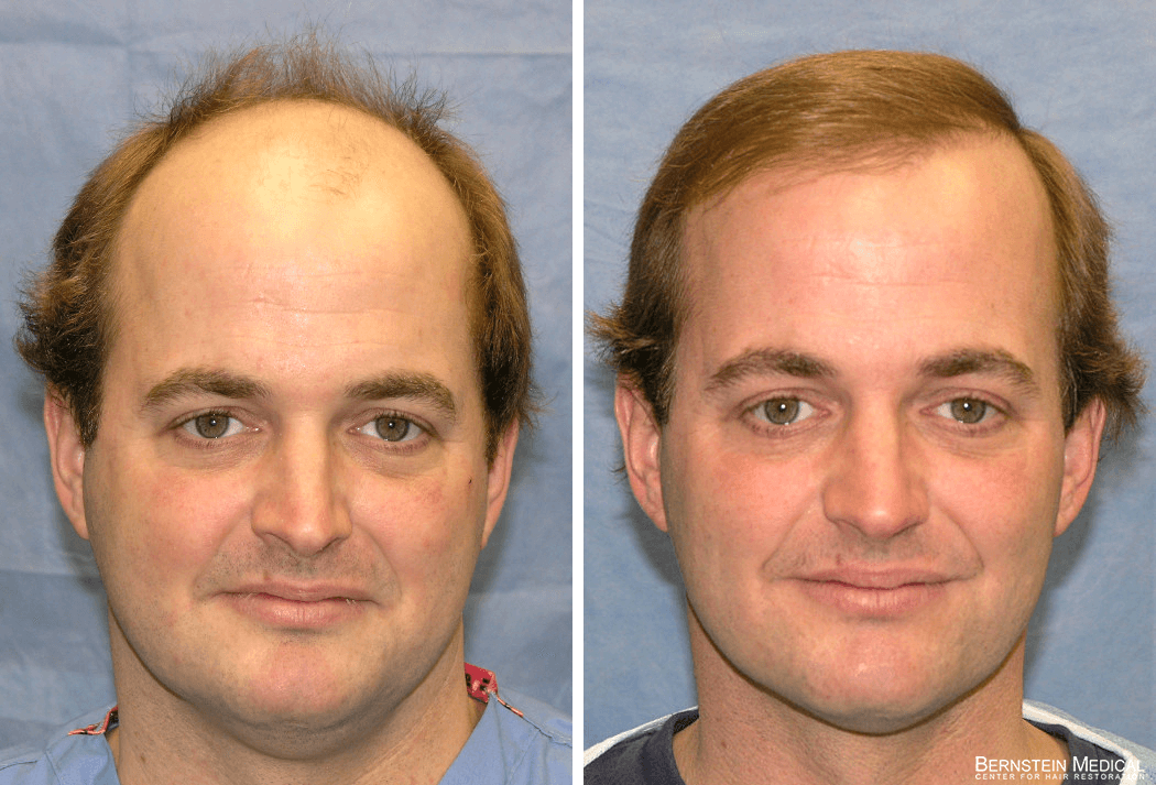 Bernstein Medical - Patient VSJ Before and After Hair Transplant Photo 