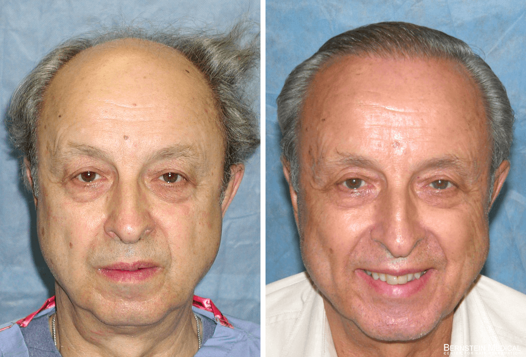 Bernstein Medical - Patient VTZ Before and After Hair Transplant Photo 