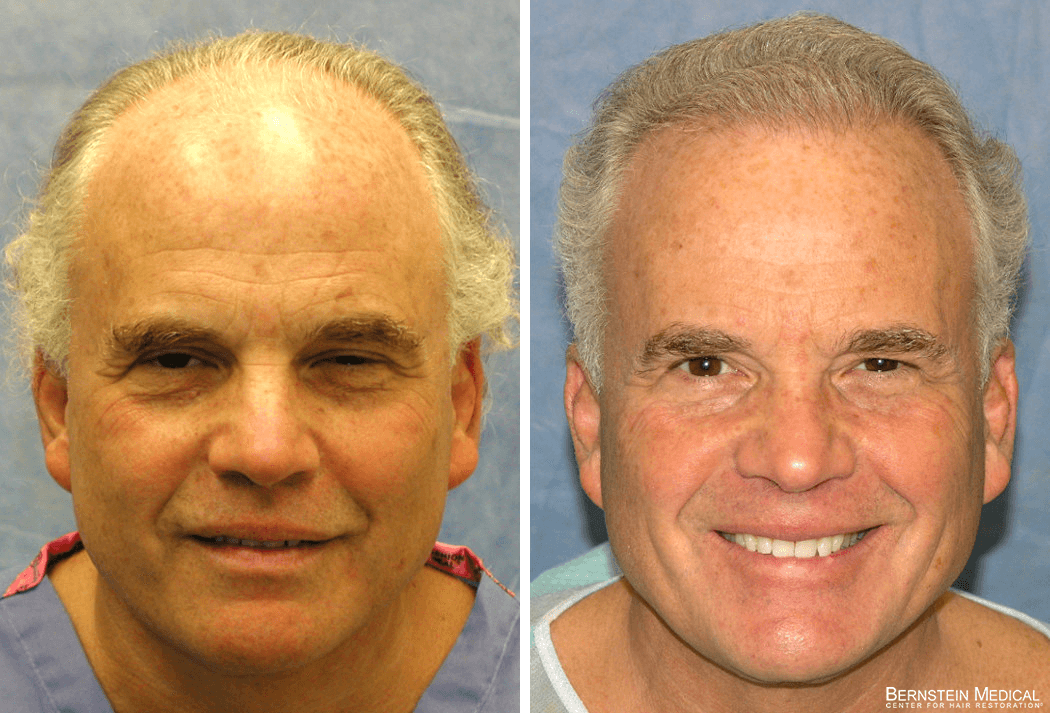Bernstein Medical - Patient YPH Before and After Hair Transplant Photo 