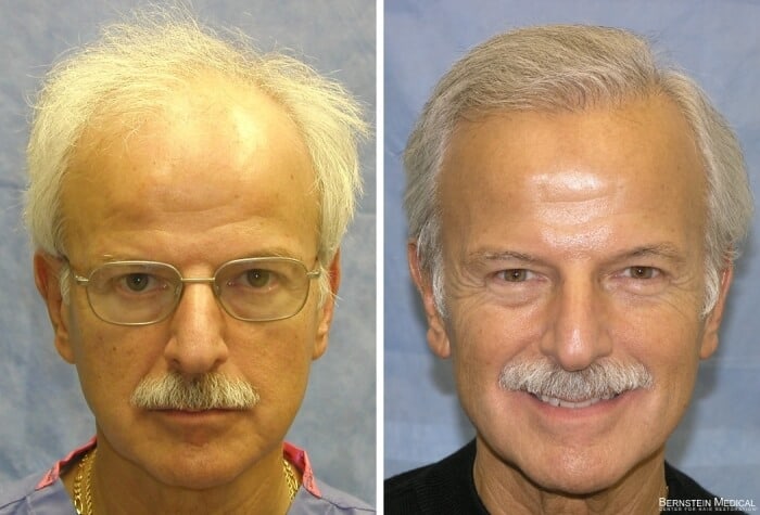Bernstein Medical - Patient ZAZ Before and After Hair Transplant Photo 