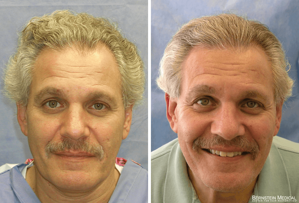 Bernstein Medical - Patient ZLA Before and After Hair Transplant Photo 