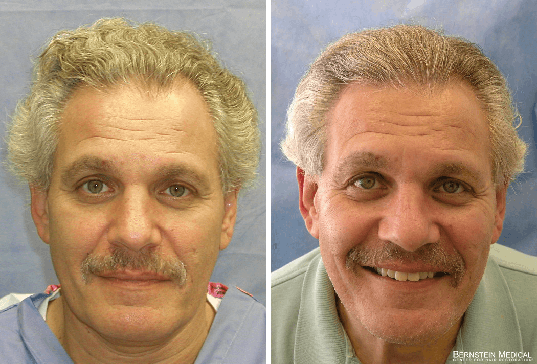 Patient ZLA | Bernstein Medical - Center for Hair Restoration Patient ZLA | Bernstein Medical - Center for Hair Restoration