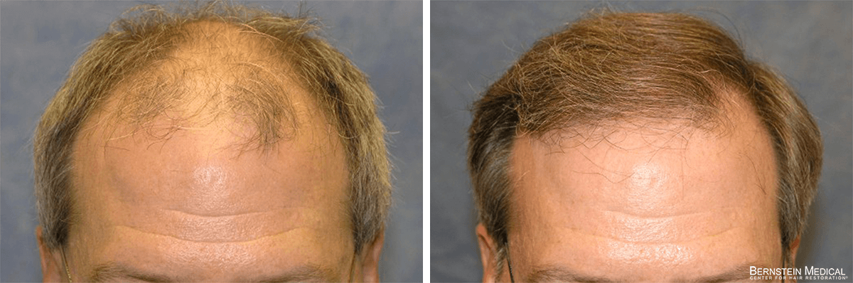Bernstein Medical - Patient AAQ Before and After Hair Transplant Photo 