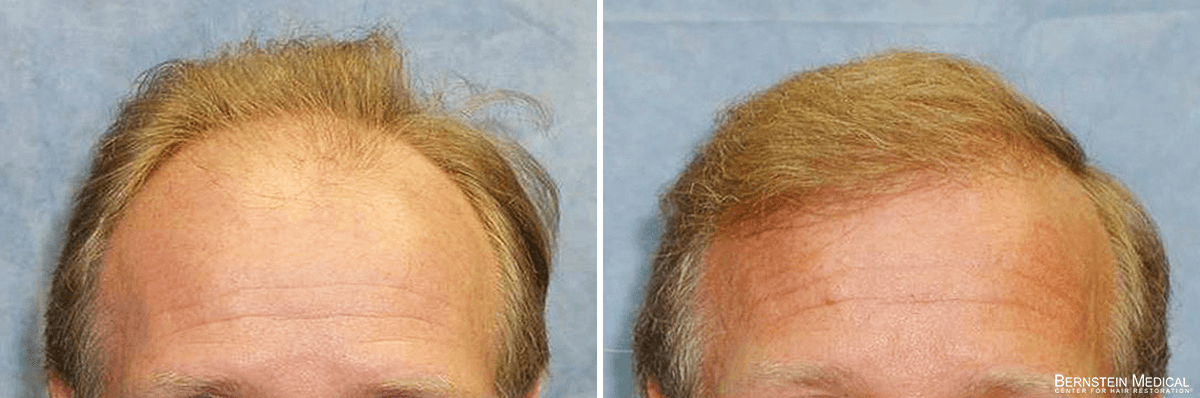 Bernstein Medical - Patient ABA Before and After Hair Transplant Photo 