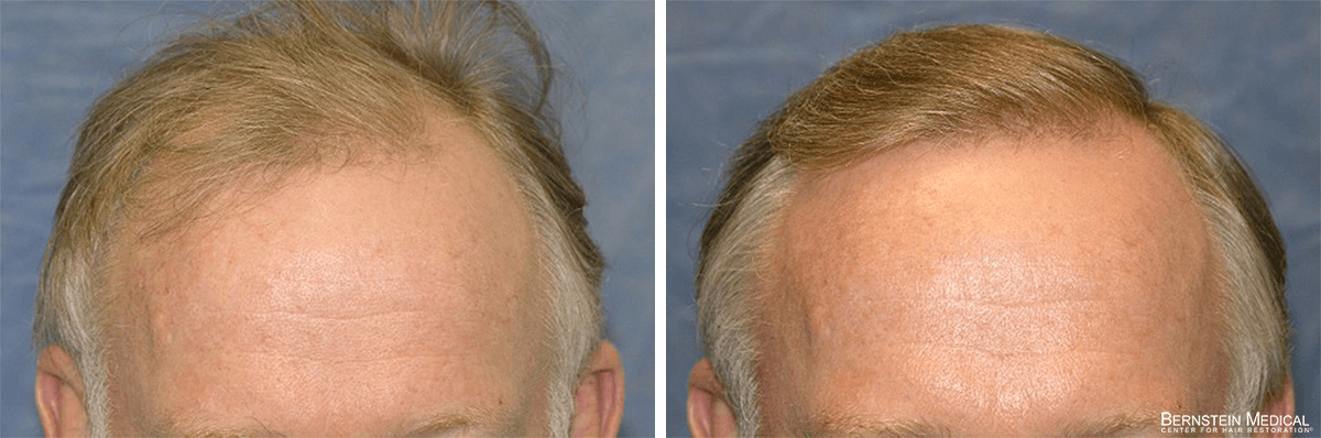 Bernstein Medical - Patient ABR Before and After Hair Transplant Photo 