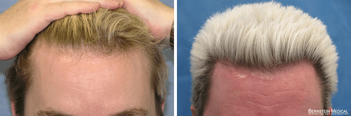 Bernstein Medical - Patient ACI Before and After Hair Transplant Photo 