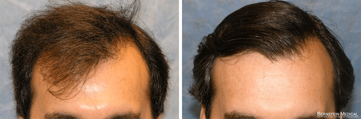 Bernstein Medical - Patient ACZ Before and After Hair Transplant Photo 