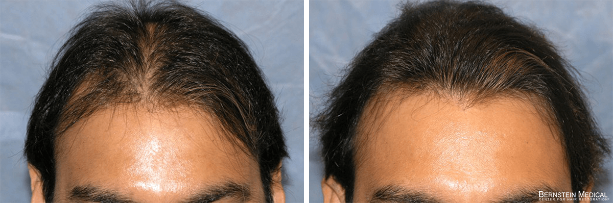 Bernstein Medical - Patient ADR Before and After Hair Transplant Photo 
