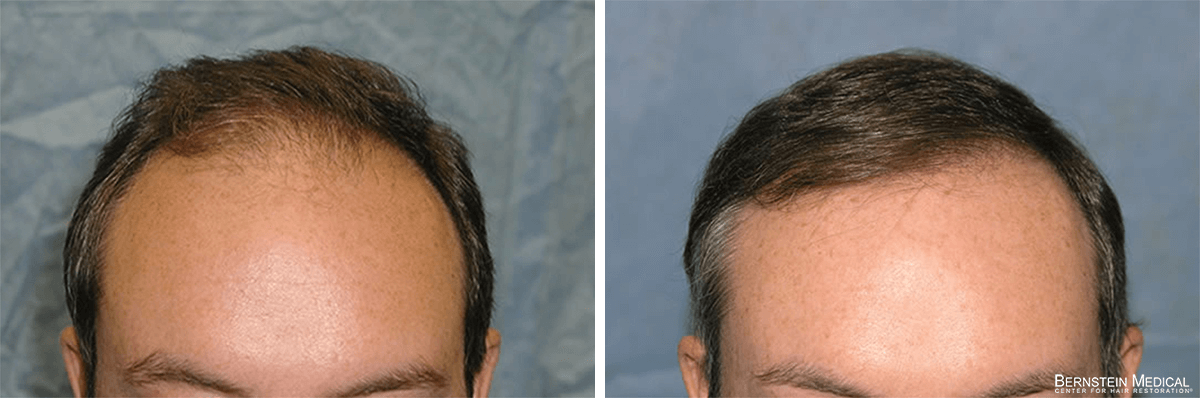Bernstein Medical - Patient AME Before and After Hair Transplant Photo 