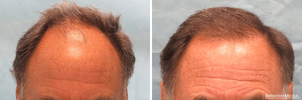 Bernstein Medical - Patient ARF Before and After Hair Transplant Photo 