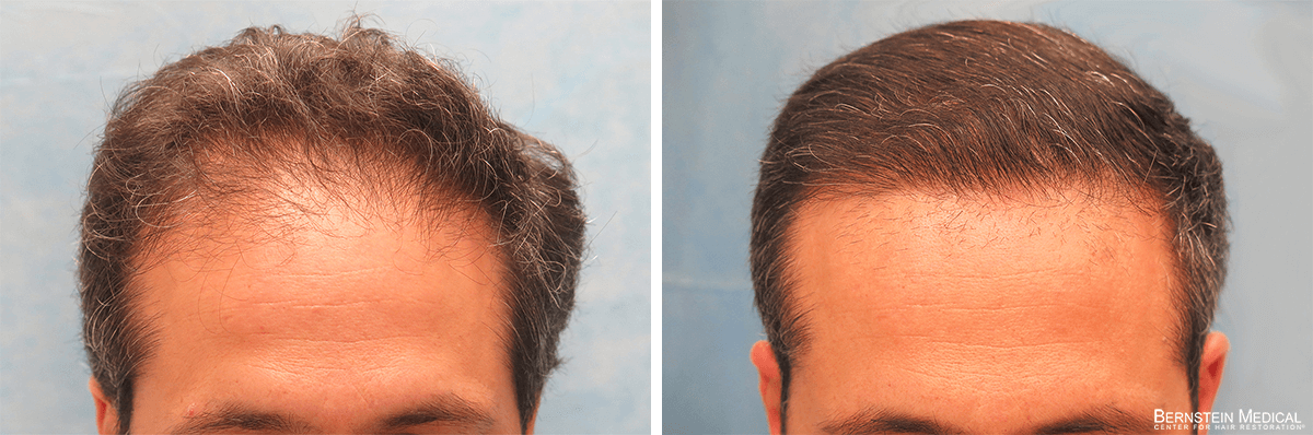 Bernstein Medical - Patient AUI Before and After Hair Transplant Photo 
