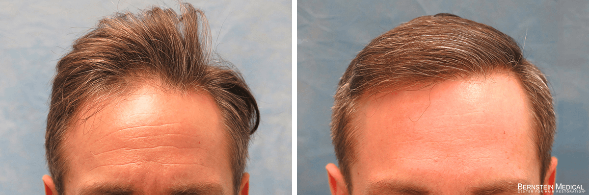 Bernstein Medical - Patient AZB Before and After Hair Transplant Photo 