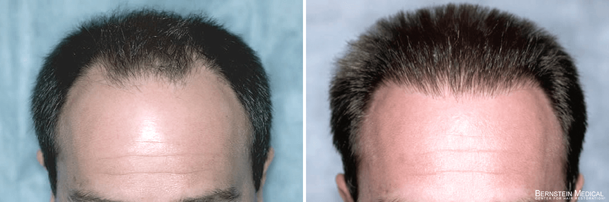 Bernstein Medical - Patient BDL Before and After Hair Transplant Photo 