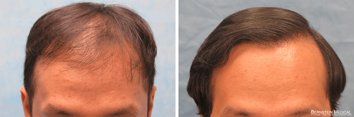 Bernstein Medical - Patient BEQ Before and After Hair Transplant Photo 