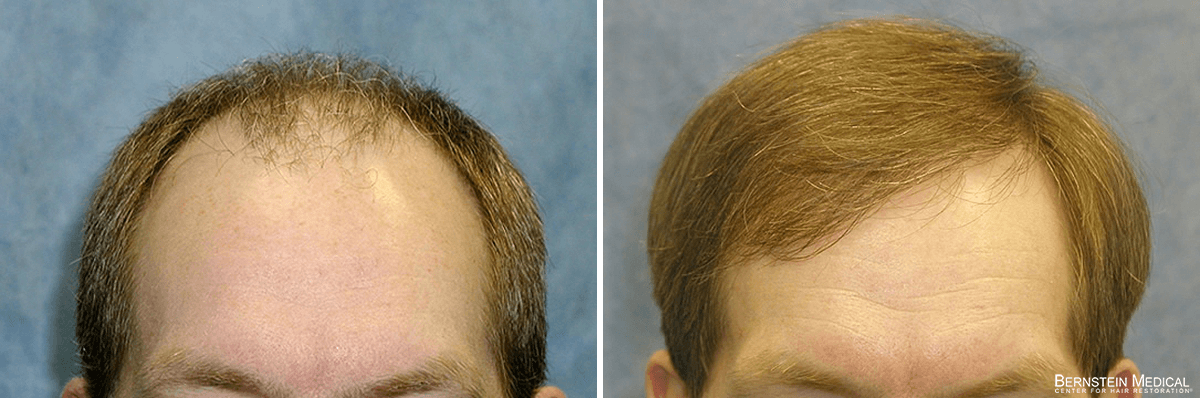 Bernstein Medical - Patient BES Before and After Hair Transplant Photo