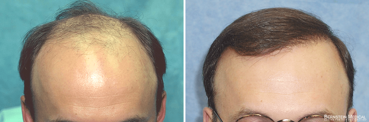 Bernstein Medical - Patient BFA Before and After Hair Transplant Photo 