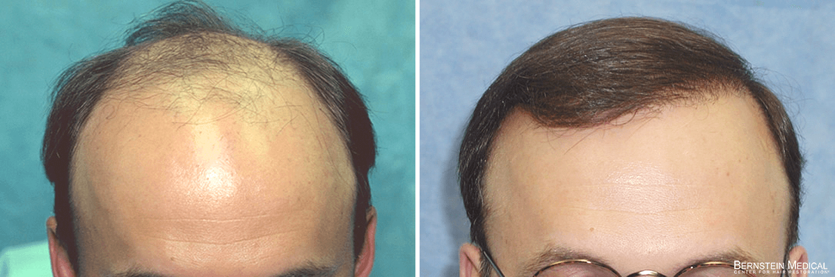 Bernstein Medical - Patient BFA Before and After Hair Transplant Photo