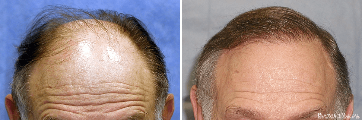 Bernstein Medical - Patient BGD Before and After Hair Transplant Photo 