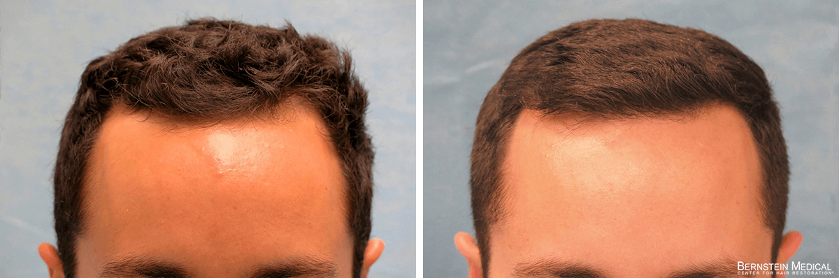 Bernstein Medical - Patient BKO Before and After Hair Transplant Photo 