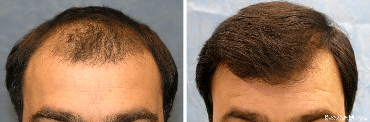 Bernstein Medical - Patient BWM Before and After Hair Transplant Photo 