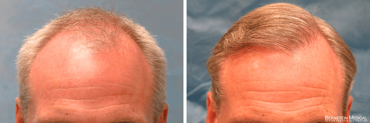 Bernstein Medical - Patient BYB Before and After Hair Transplant Photo 