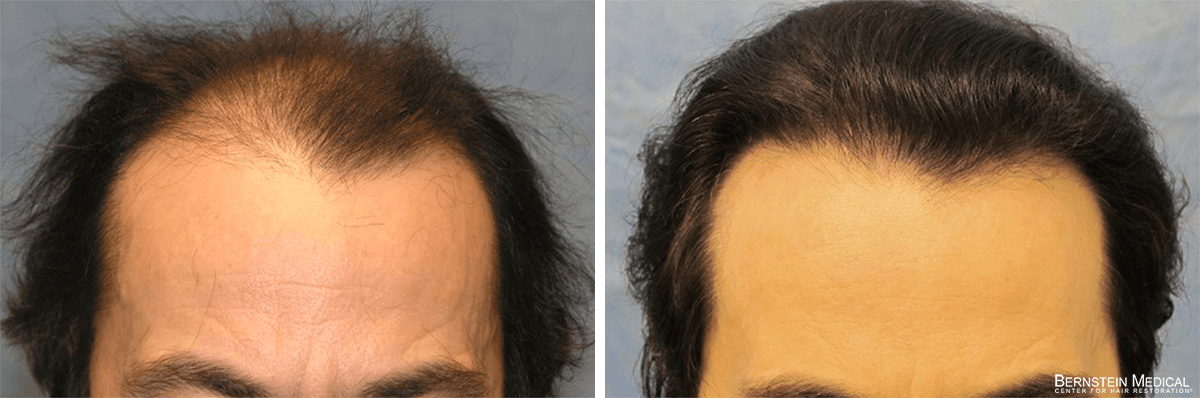 Bernstein Medical - Patient CJR Before and After Hair Transplant Photo 