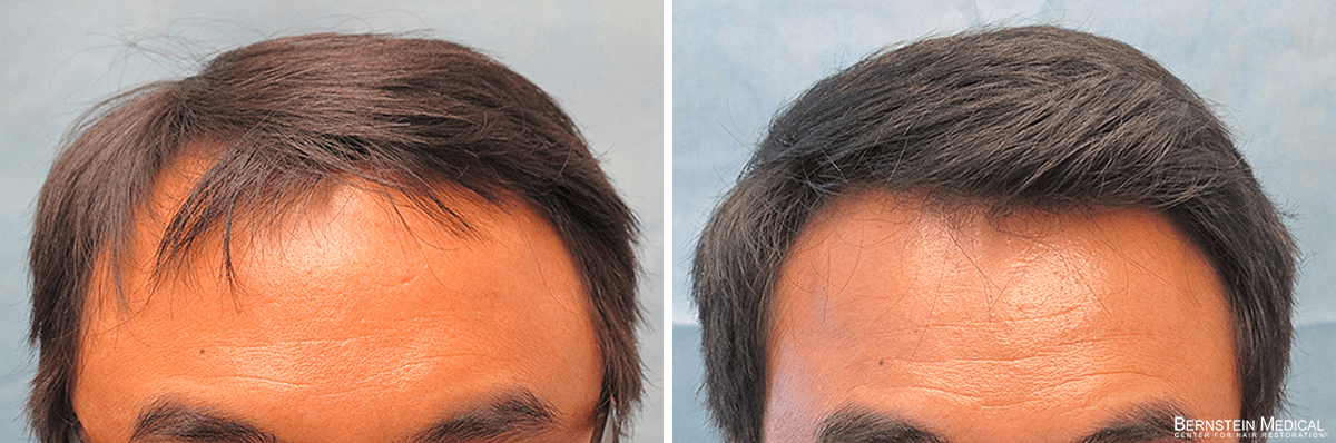 Bernstein Medical - Patient CXD Before and After Hair Transplant Photo 