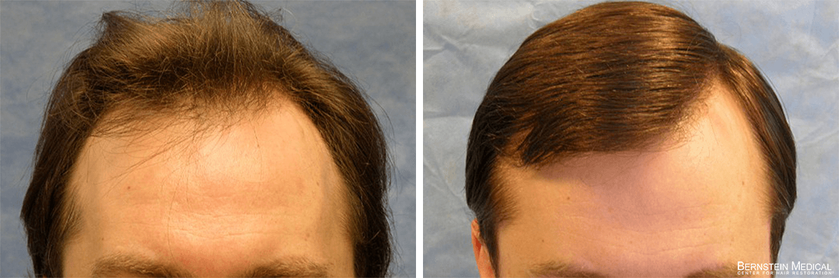 Bernstein Medical - Patient CXT Before and After Hair Transplant Photo 