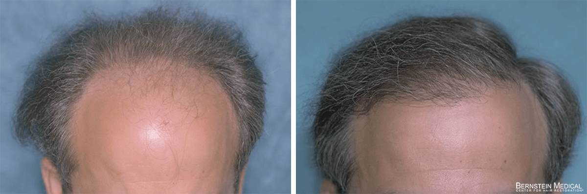 Bernstein Medical - Patient CZQ Before and After Hair Transplant Photo 