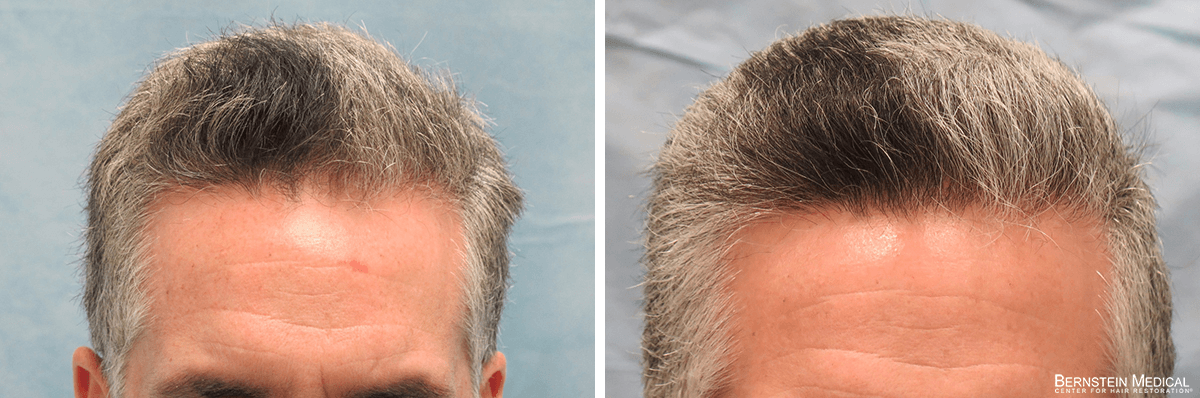 Bernstein Medical - Patient EBL Before and After Hair Transplant Photo 