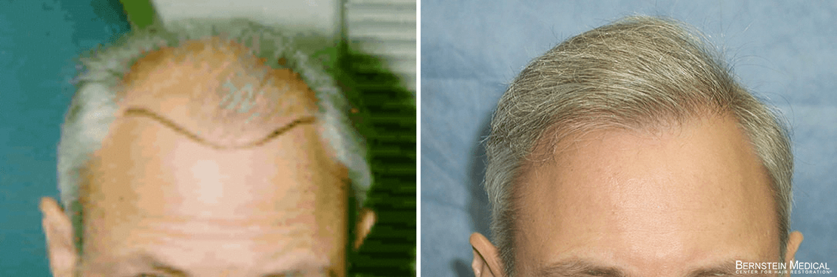 Bernstein Medical - Patient EHI Before and After Hair Transplant Photo 