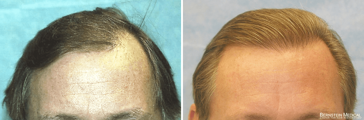 Bernstein Medical - Patient EIQ Before and After Hair Transplant Photo 