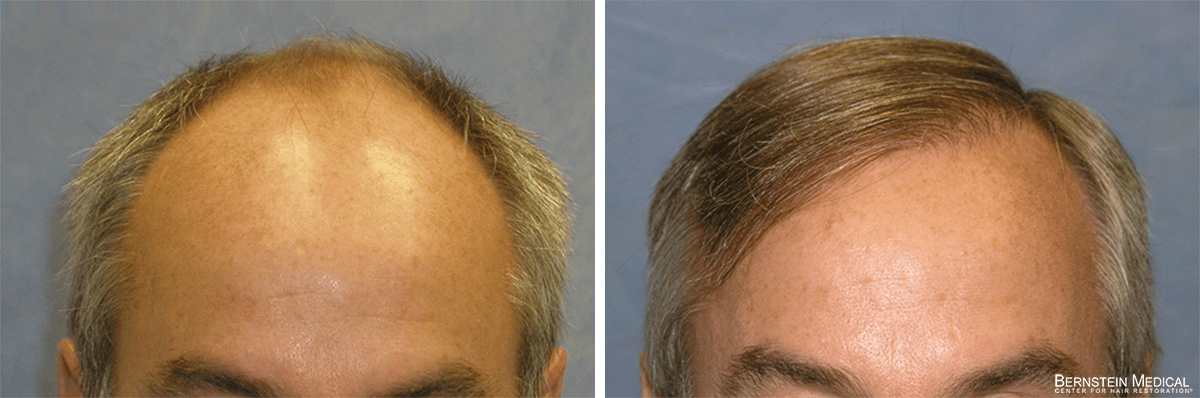 Bernstein Medical - Patient EOK Before and After Hair Transplant Photo 