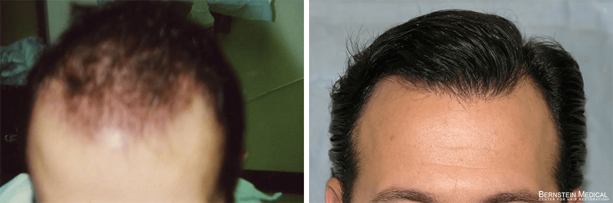 Bernstein Medical - Patient EPQ Before and After Hair Transplant Photo 